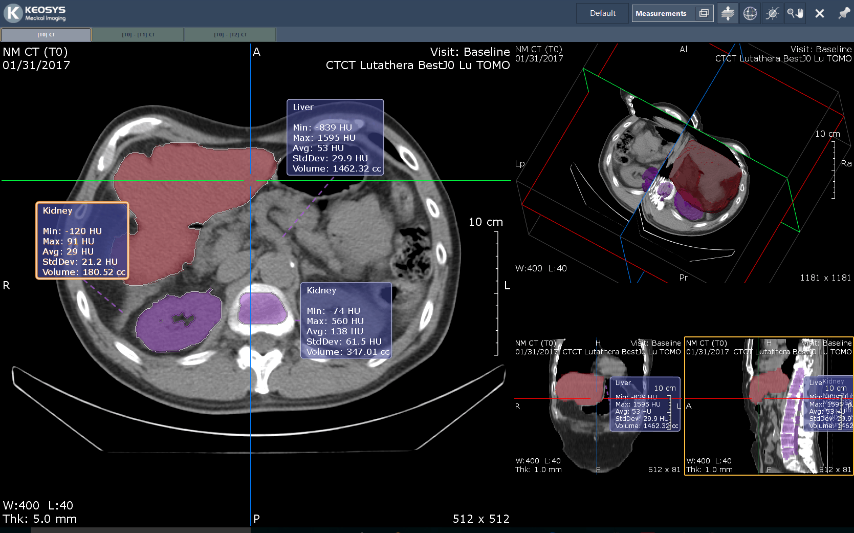 ADVANCED-LESION-MEASUREMENT-TOOLS-DEVELOPED-FOR-CLINICAL-TRIALS-copy